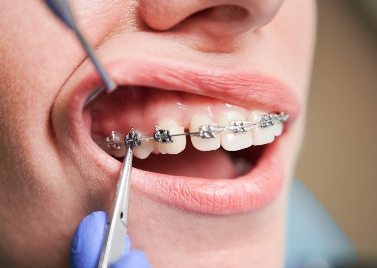 El irrigador bucal Waterpik® es 3X más eficaz que el hilo dental para pacientes ortodónticos